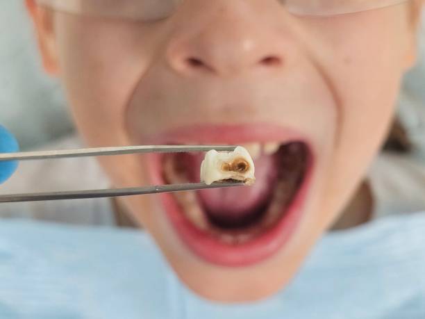 Best Urgent Care for Lost Fillings or Crowns in Burns Flat, OK